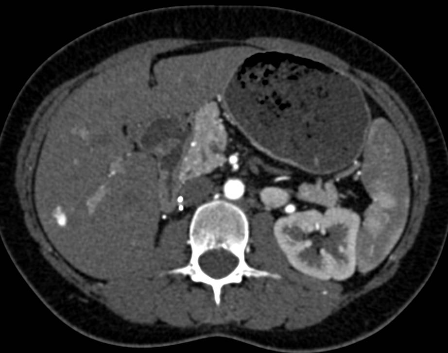 Flash Filling Hepatic Hemangiomas Liver Case Studies CTisus CT Scanning