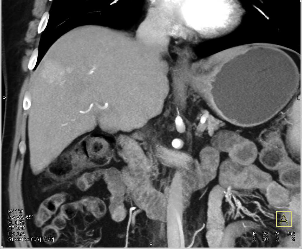Vascular Lesion in the Right Lobe of the Liver Liver Case Studies
