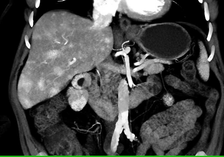 Metastatic Neuroendocrine Tumor to the Liver Best Seen on Arterial