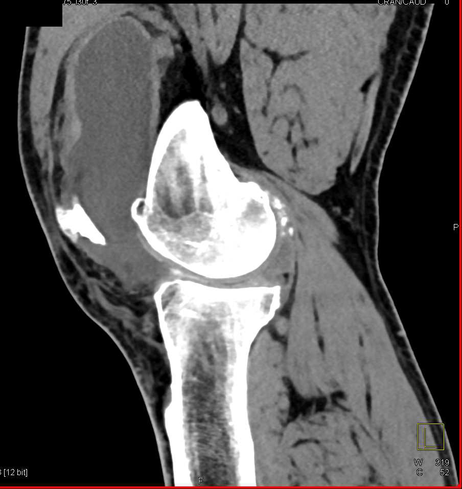 Degenerative Change with Joint Effusion Musculoskeletal Case Studies