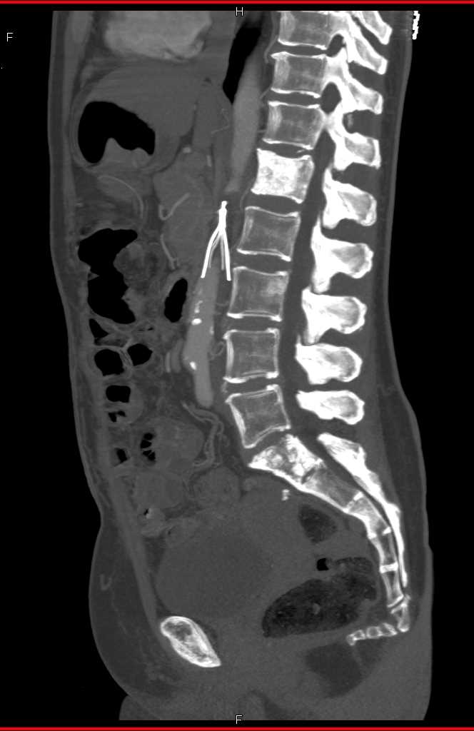 Bladder Cancer with Blastic Bone Metastases Musculoskeletal Case