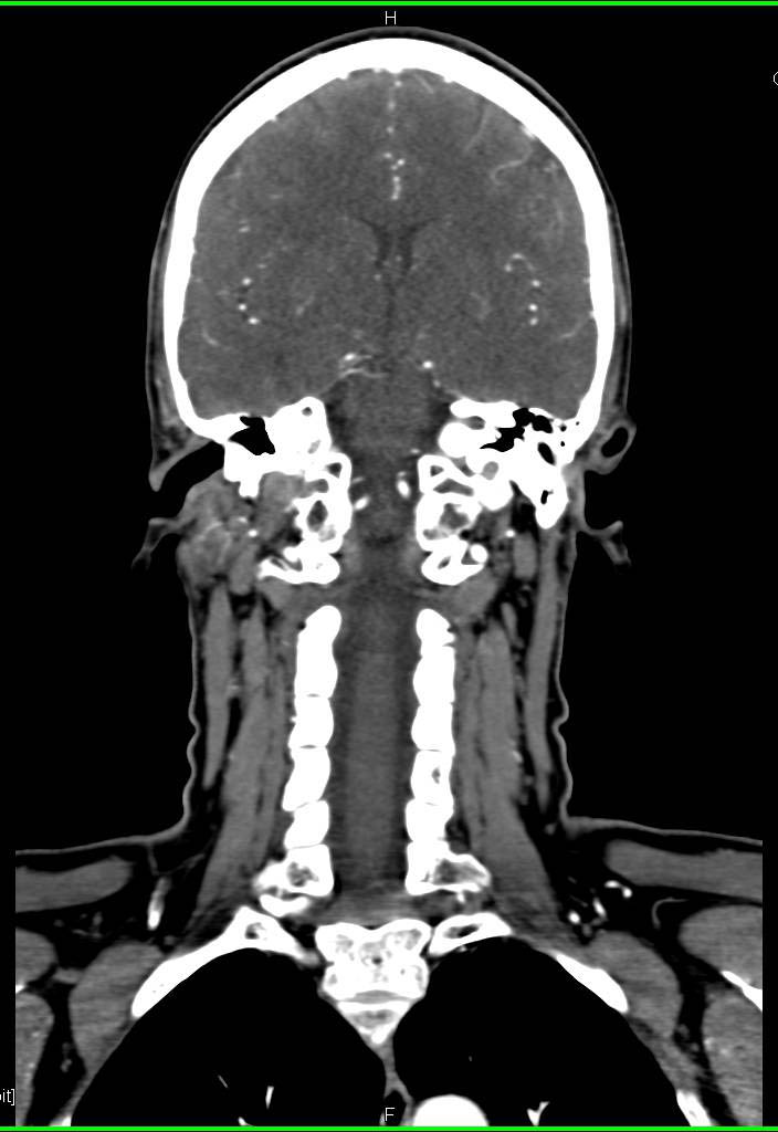 Normal CTA of the Head and Neck Neuro Case Studies CTisus CT Scanning