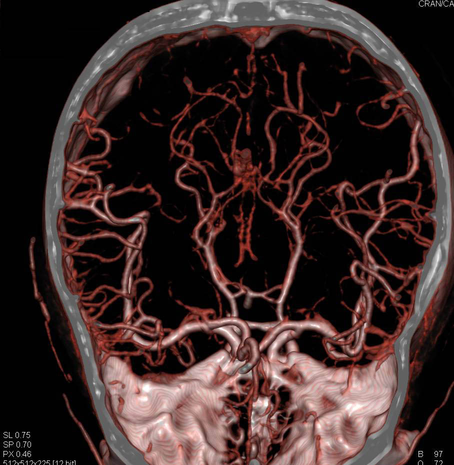 CTA of the Brain Neuro Case Studies CTisus CT Scanning