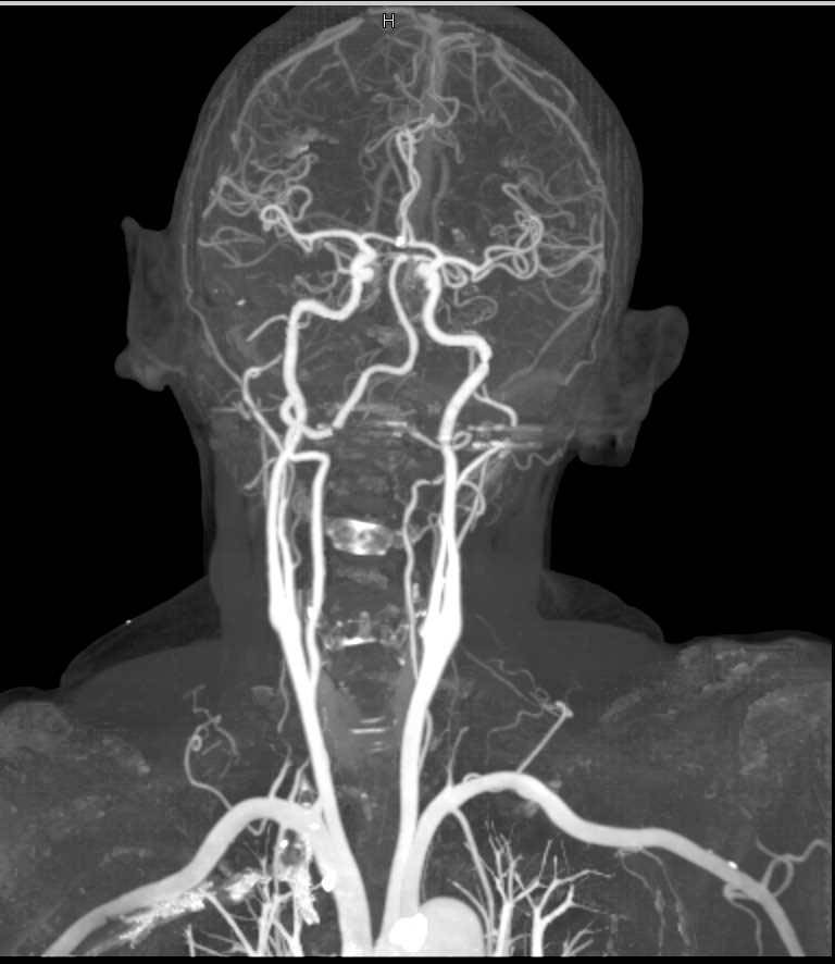 CTA of the Carotid Arteries with Dual Energy Neuro Case Studies
