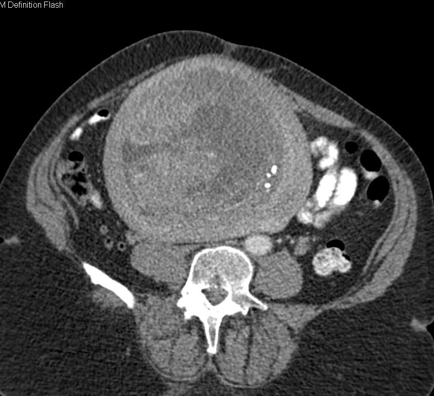 Degenerating Uterine Fibroid OB/GYN Case Studies CTisus CT Scanning