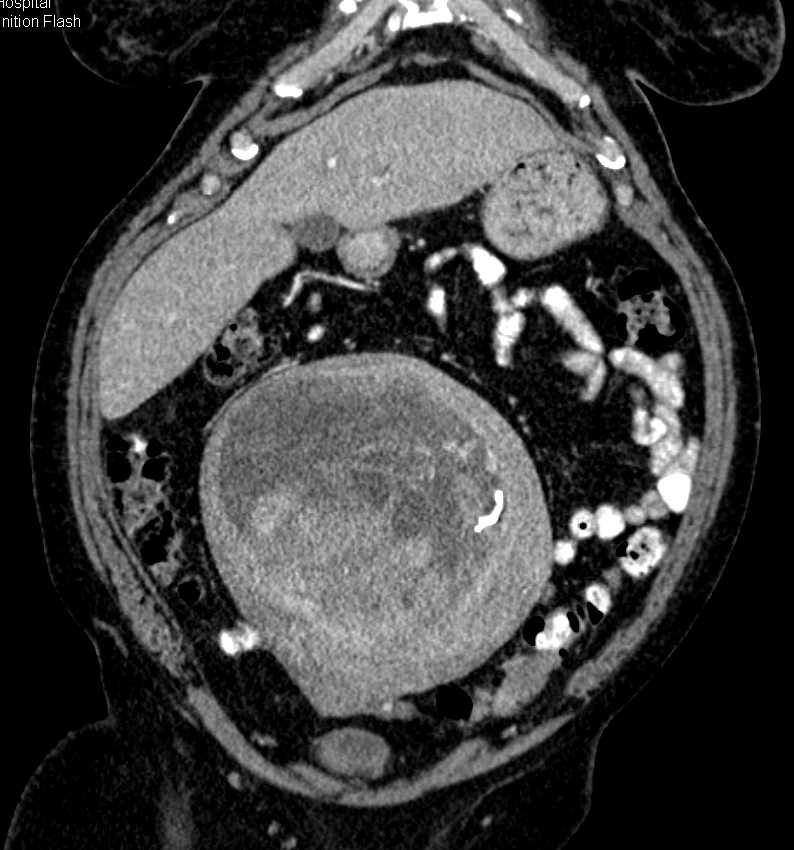 Degenerating Uterine Fibroid OB/GYN Case Studies CTisus CT Scanning