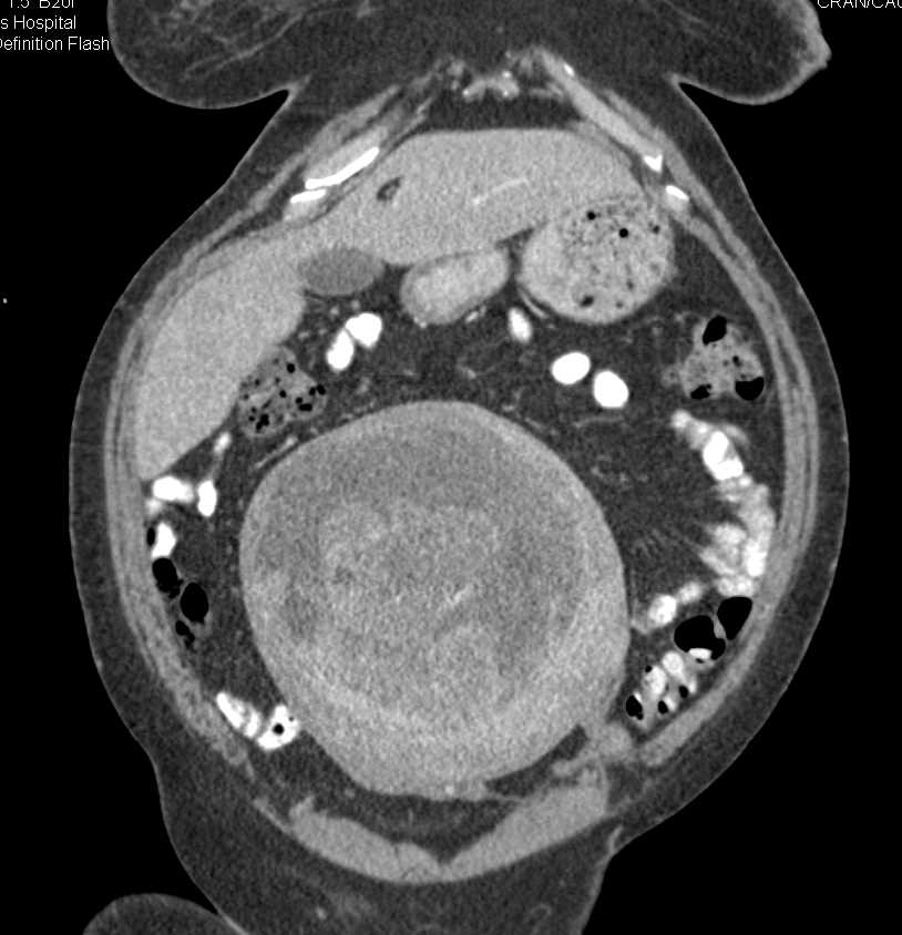 Degenerating Uterine Fibroid OB/GYN Case Studies CTisus CT Scanning