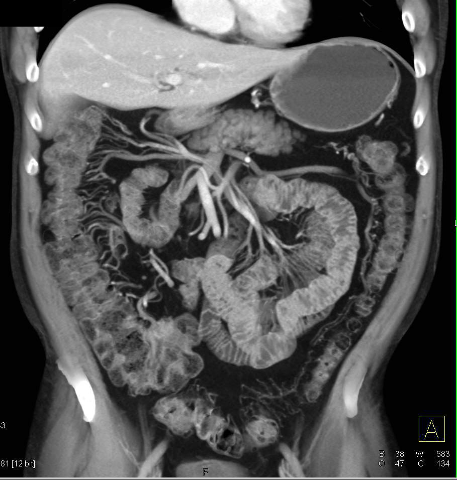 Lymphocytic Colitis with Nice Vasa Recta Small Bowel Case Studies
