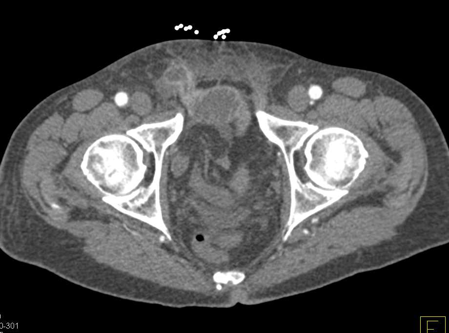 Inguinal Hernia Ct Scan Images ct scan machine
