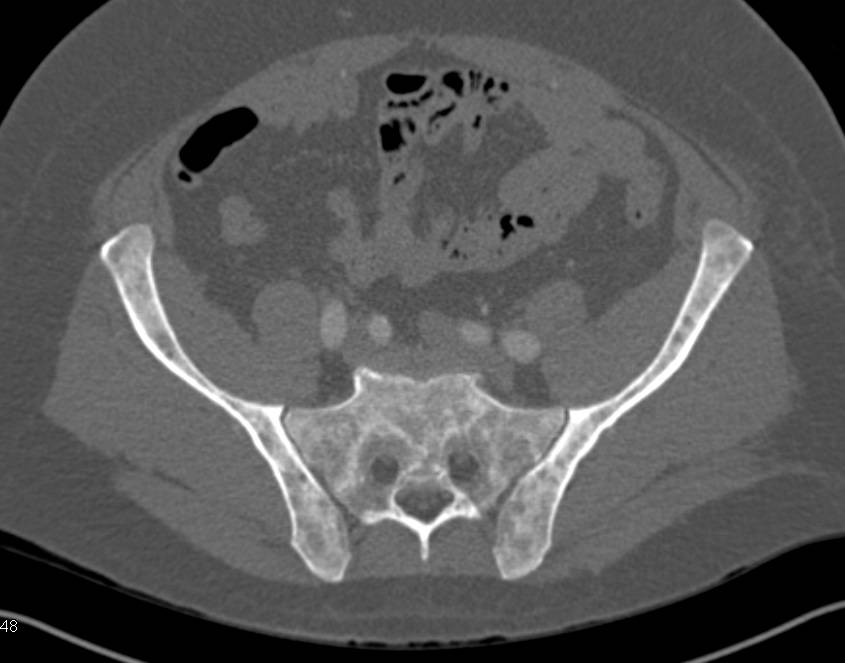 Myelofibrosis with Sclerotic Bone Lesions and Splenomegaly