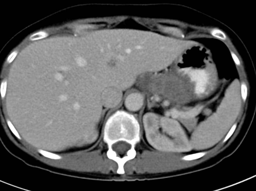 Recurrent Gastric Cancer Stomach Case Studies CTisus