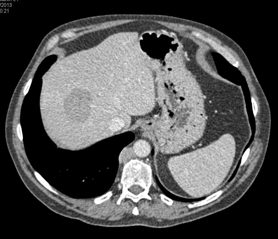 Gastric Cancer with Extensive Adenopathy Stomach Case