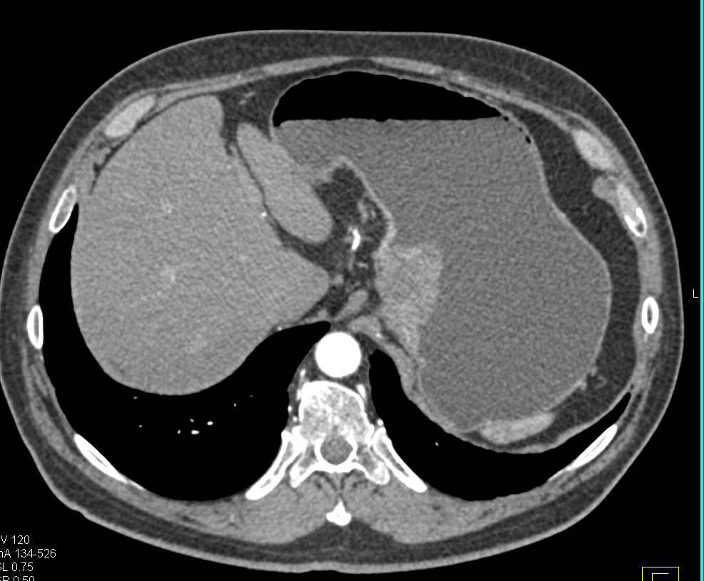 Gastric Cancer with Bulky Paraaortic Adenopathy Stomach