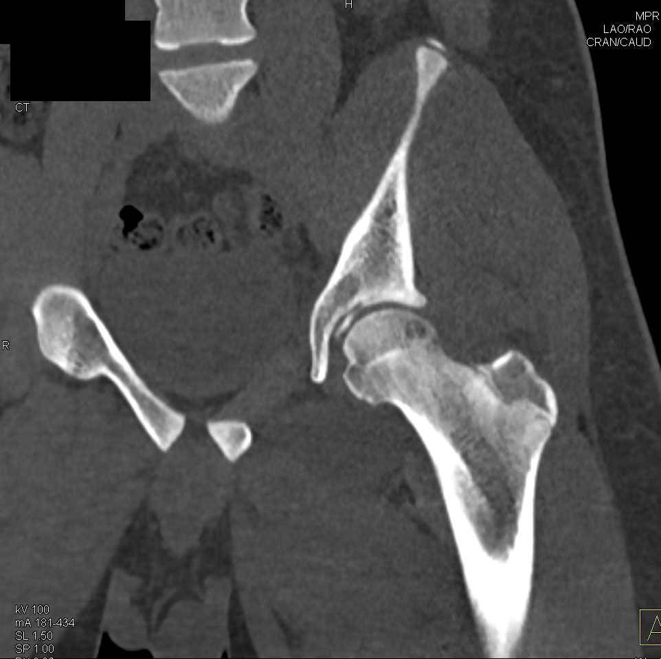 Intraarticular Fragment in the Left Hip Joint Following Left Hip
