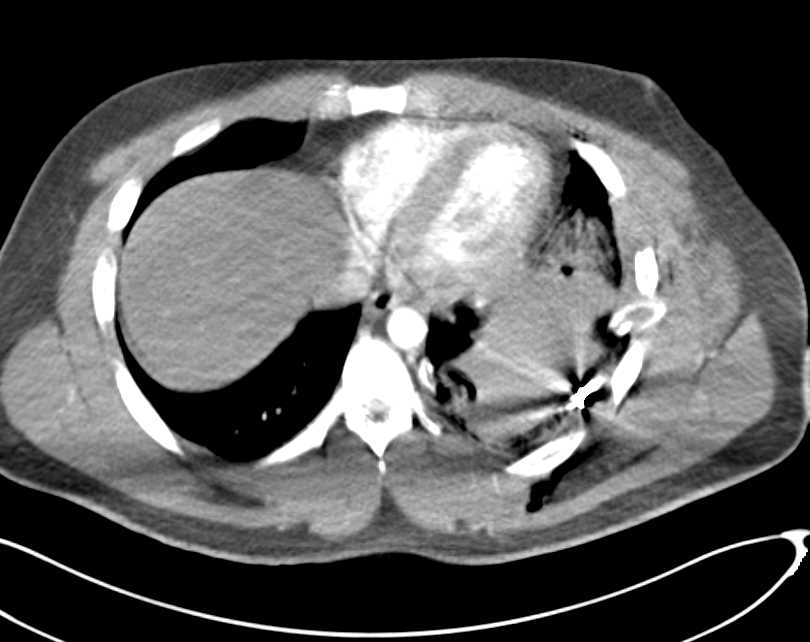 Trauma with Pulmonary Contusion and Rib Fractures Trauma Case Studies