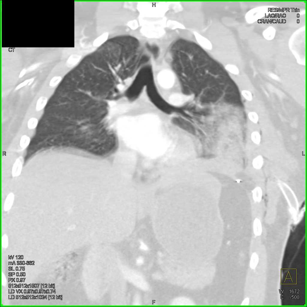 Trauma with Pulmonary Contusion and Rib Fractures Trauma Case Studies
