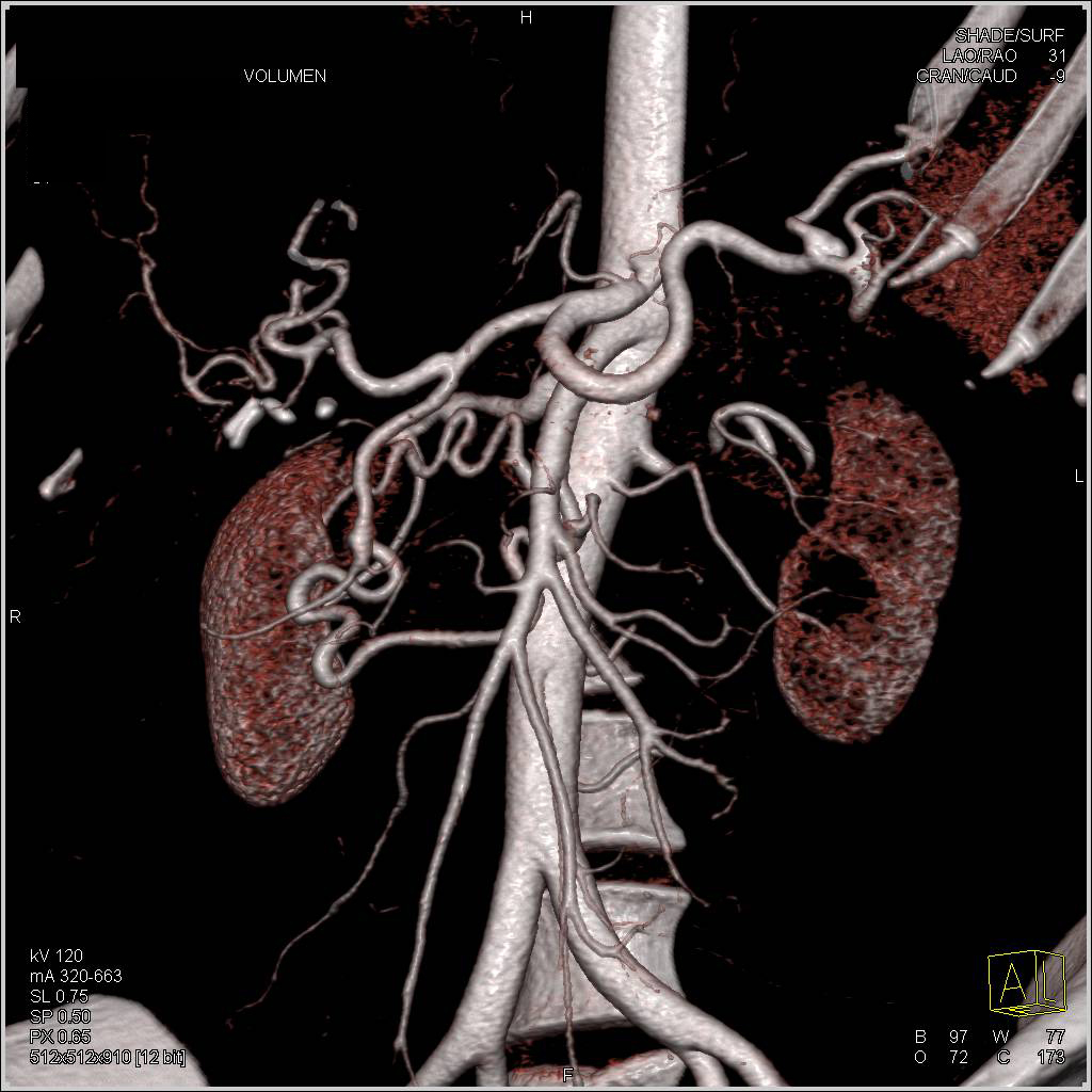 Stenosis Celiac Artery Origin with Flow Through Gastroduodenal Artery