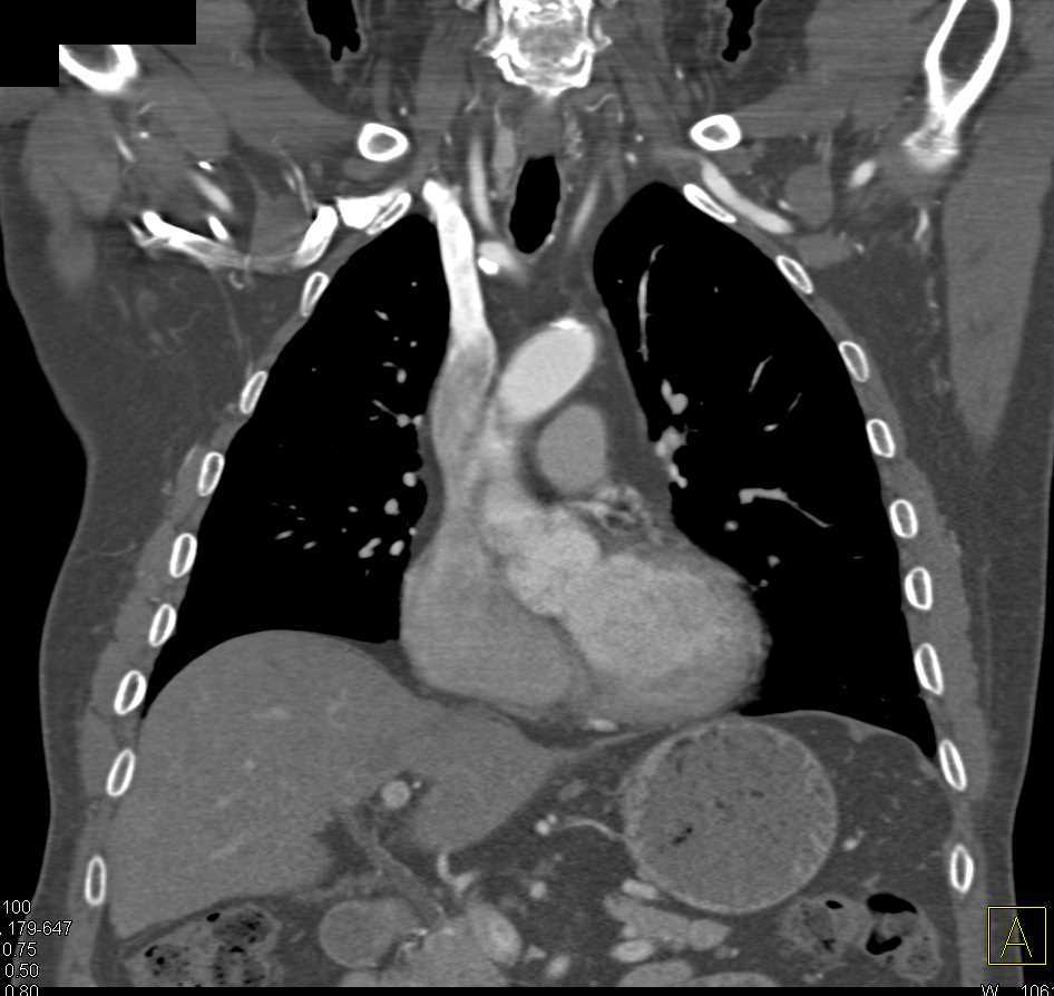 Stent in Left Subclavian Artery Vascular Case Studies CTisus CT Scanning