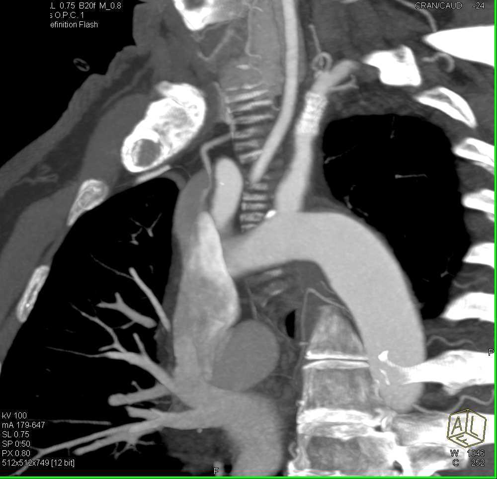 Stent in Left Subclavian Artery Vascular Case Studies CTisus CT Scanning