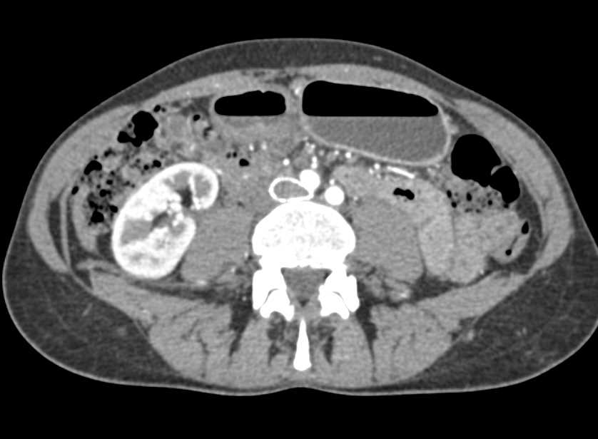 Stent in Left Iliac Vein in Patient with MayThurner Syndrome
