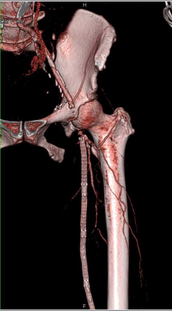 Occluded Left Femoral Artery with Stent Graft Vascular