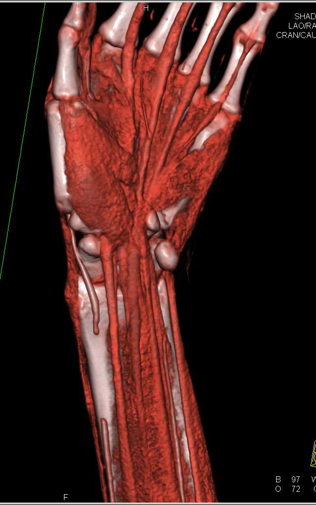 Radial Artery Occlusion Vascular Case Studies CTisus CT Scanning