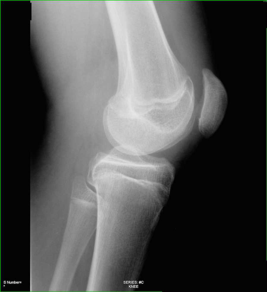 Fracture of Patella on Xray X Rays Case Studies CTisus CT Scanning