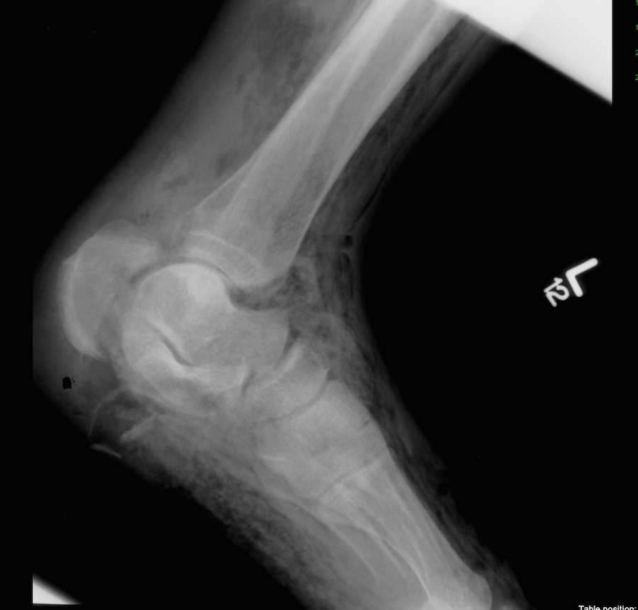 Gangrene of the Foot with SoftTissue Gas on Xray X Rays Case