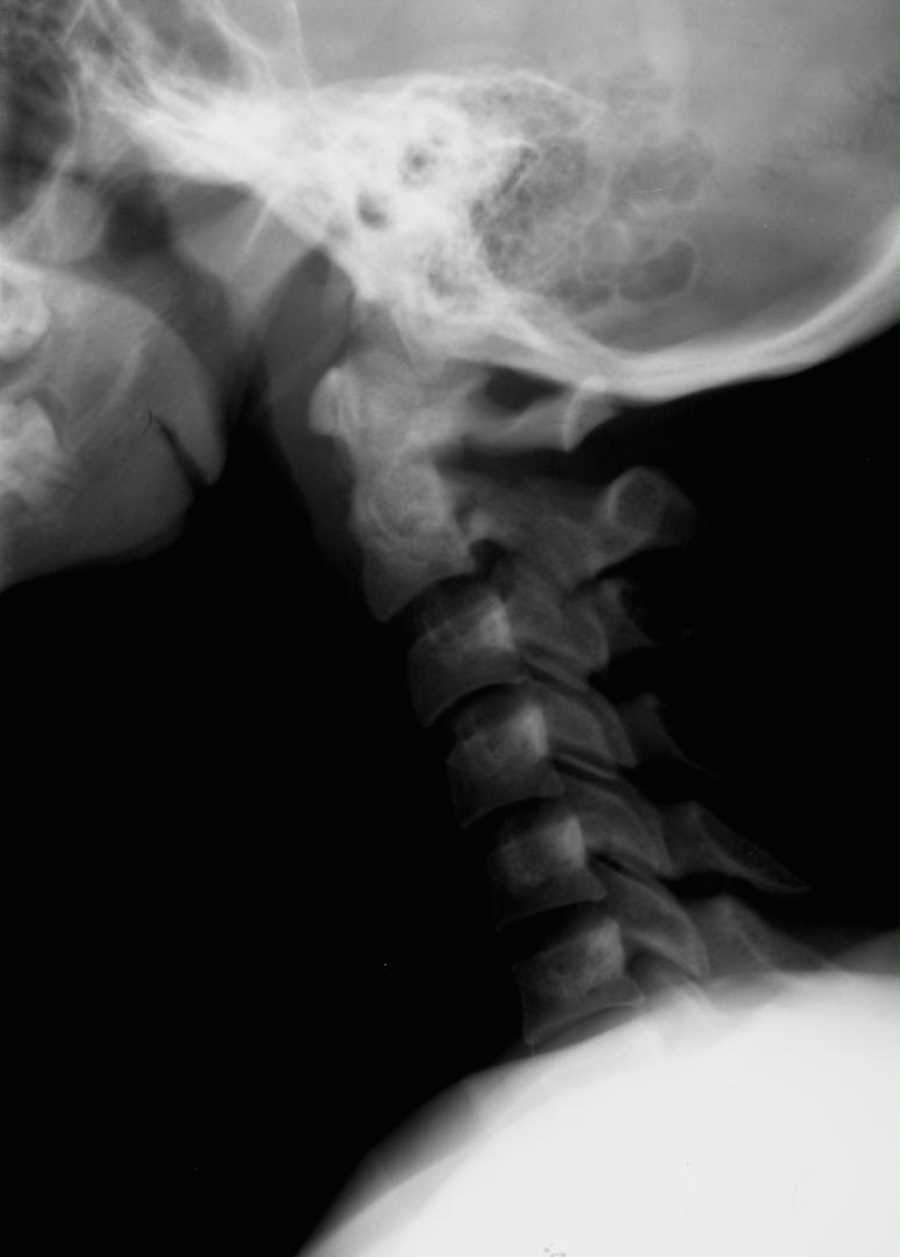 Hangman's Fracture on Xray X Rays Case Studies CTisus CT Scanning