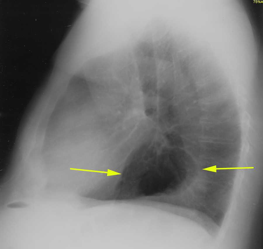 Hiatal Hernia on chest Xray X Rays Case Studies CTisus CT Scanning