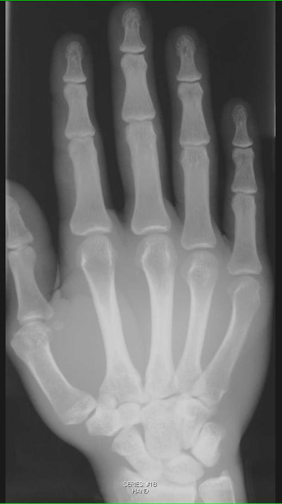 Xray Hand with soft tissue swelling X Rays Case Studies CTisus CT