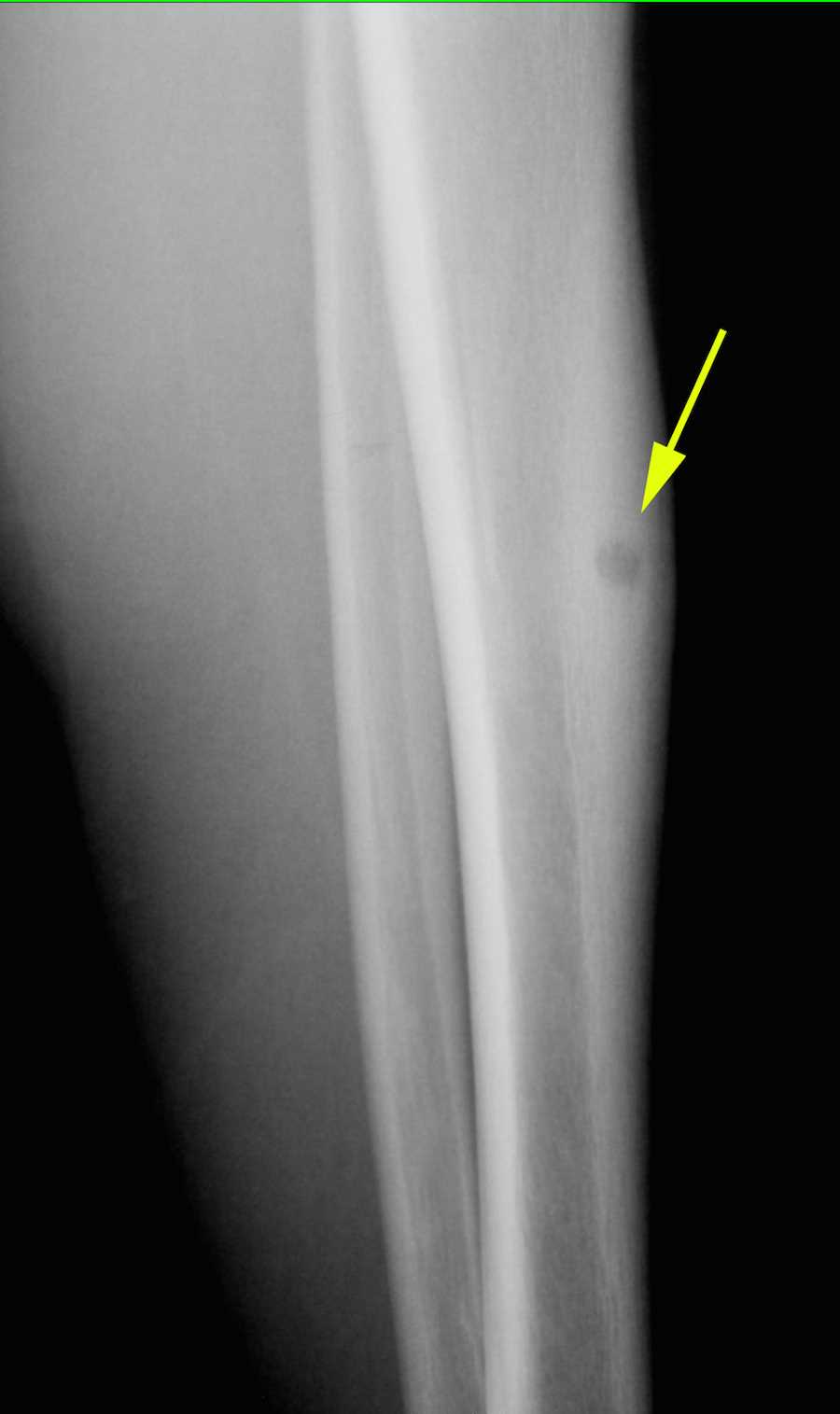 Osteoid Osteoma Tibia on Xray X Rays Case Studies CTisus CT Scanning