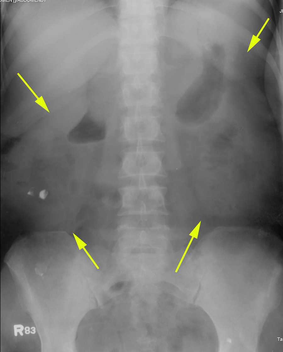 X Ray Of Swollen Kidney