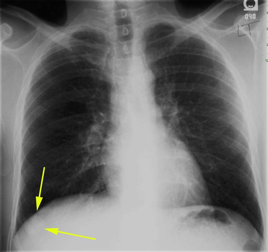 Pulmonary AVM on Chest Xray X Rays Case Studies CTisus CT Scanning