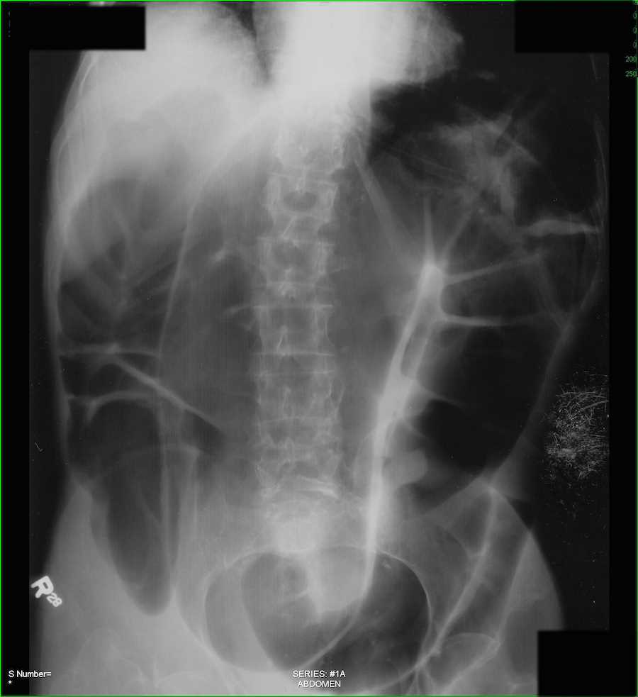 Sigmoid Volvulus on Abdominal Xray X Rays Case Studies CTisus CT