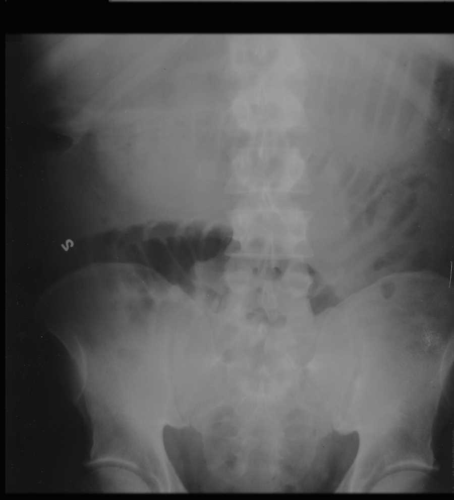 Small Bowel Obstruction on Xray X Rays Case Studies CTisus CT Scanning