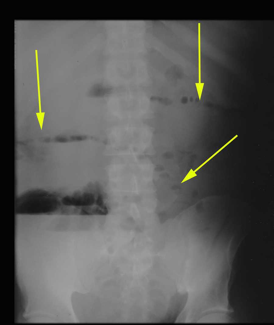 Small Bowel Obstruction on Xray X Rays Case Studies CTisus CT Scanning