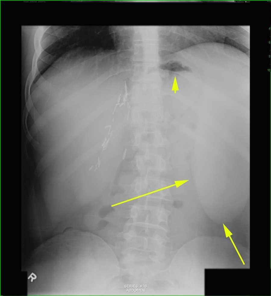 Splenomegaly on Abdominal Xray X Rays Case Studies CTisus CT Scanning