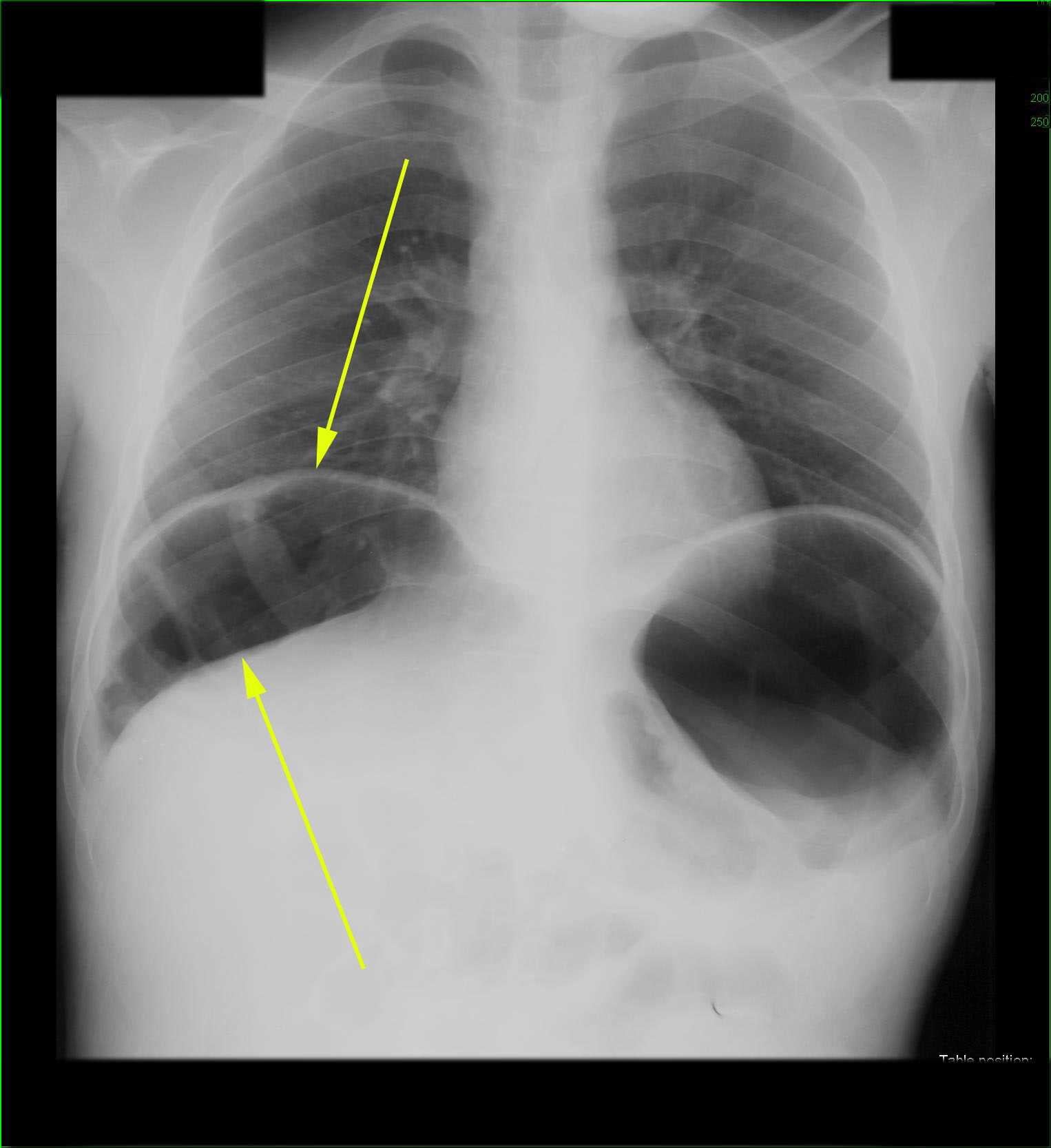 Interposition of colon under right Hemidiaphragm on Xray X Rays Case