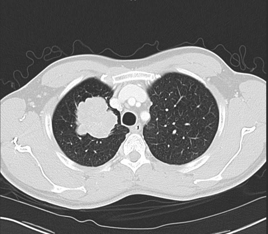 Right Upper Lobe Lung Cancer on Xray and CT X Rays Case Studies