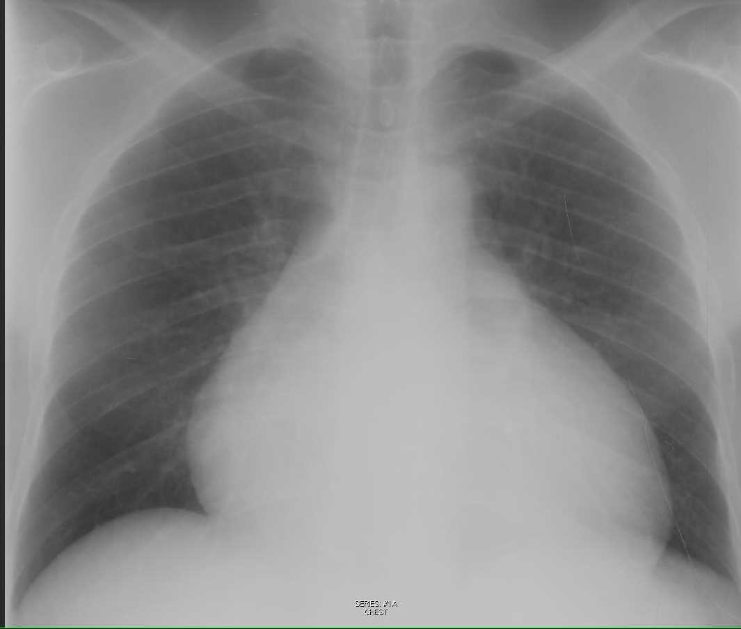Pericardial Effusion on Chest Xray X Rays Case Studies CTisus CT