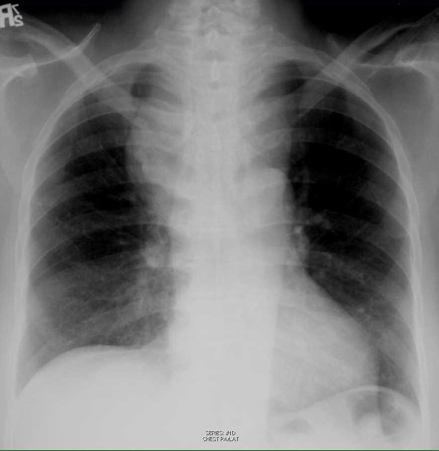 Thyroid Goiter on Chest Xray X Rays Case Studies CTisus CT Scanning