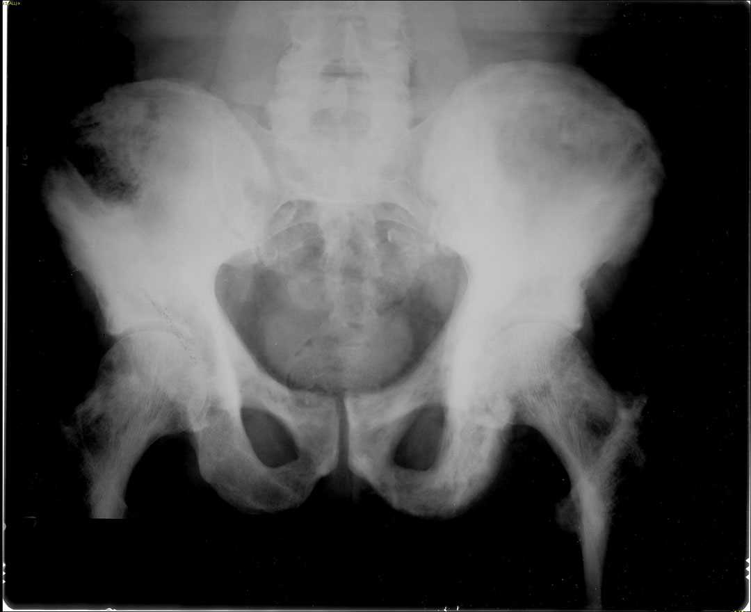 Paget's Disease X Rays Case Studies CTisus CT Scanning