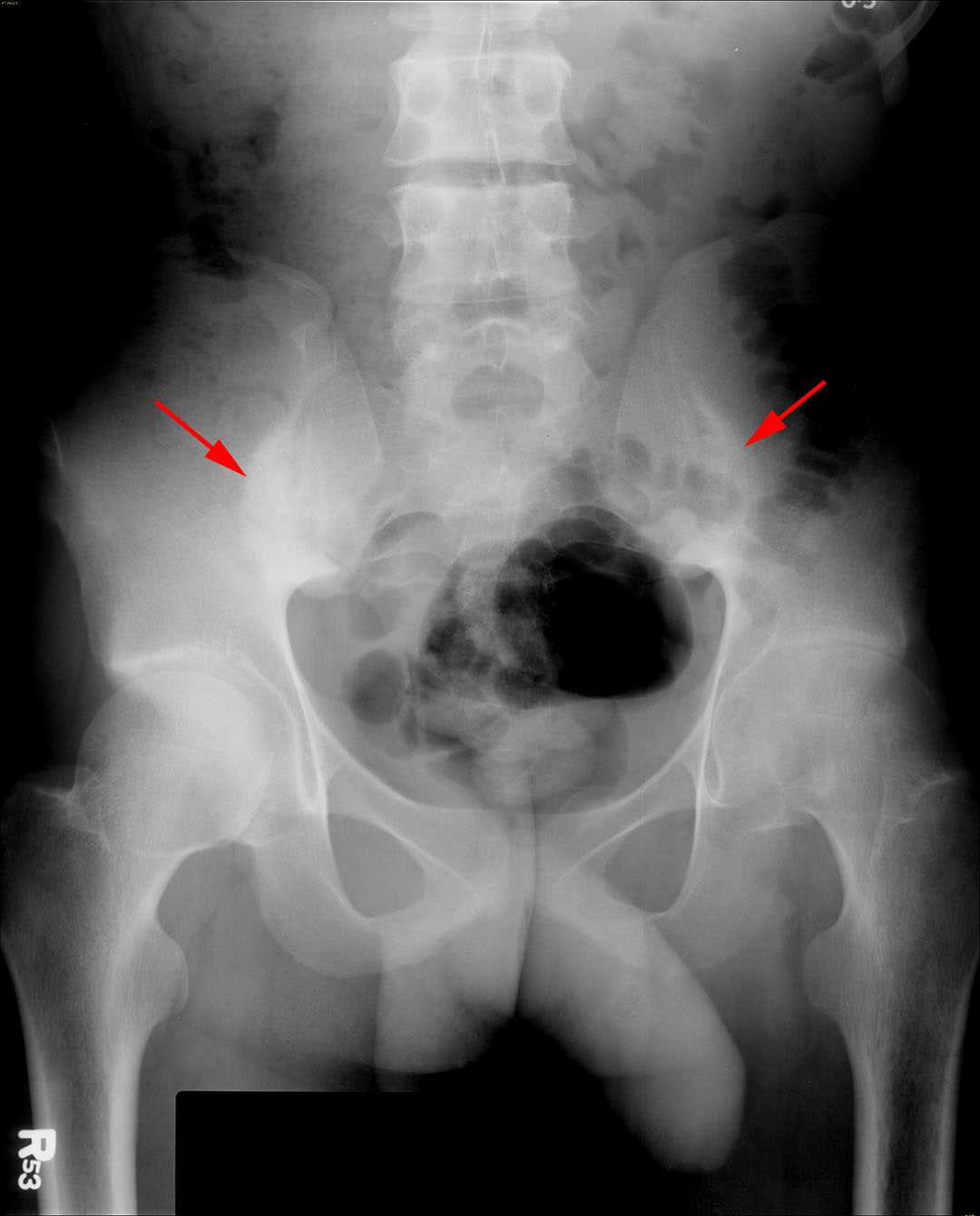 Ankylosing spondylitis X Rays Case Studies CTisus CT Scanning