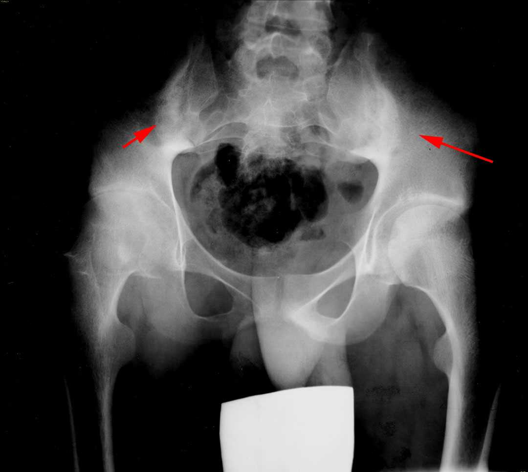 Ankylosing spondylitis X Rays Case Studies CTisus CT Scanning
