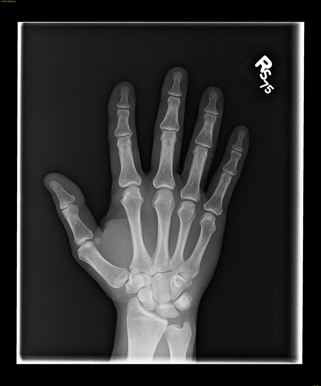 Triquetral fracture X Rays Case Studies CTisus CT Scanning