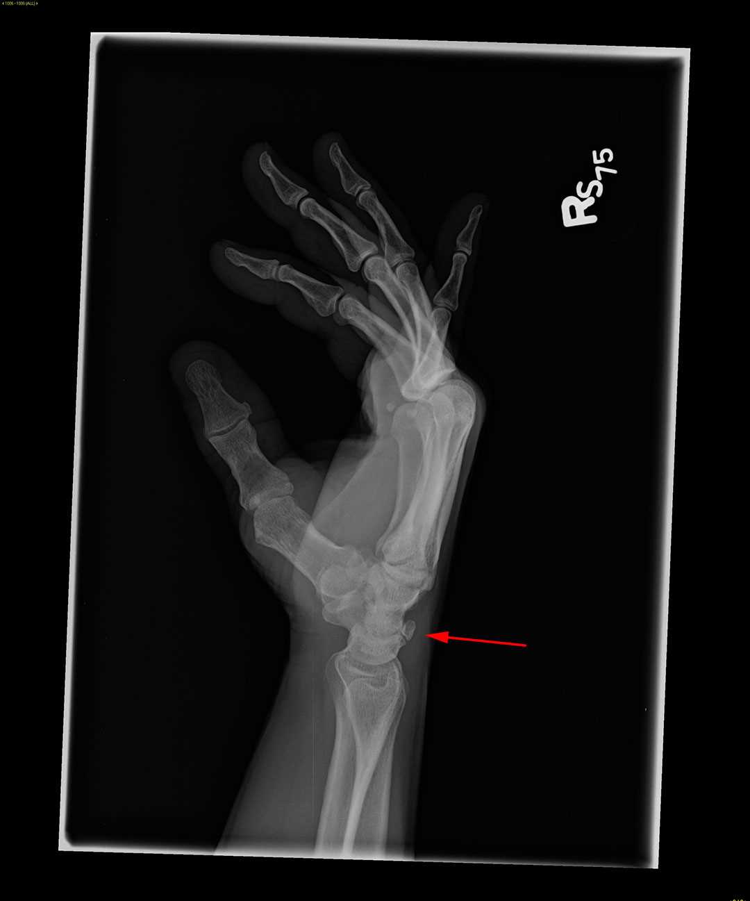 Triquetral fracture X Rays Case Studies CTisus CT Scanning