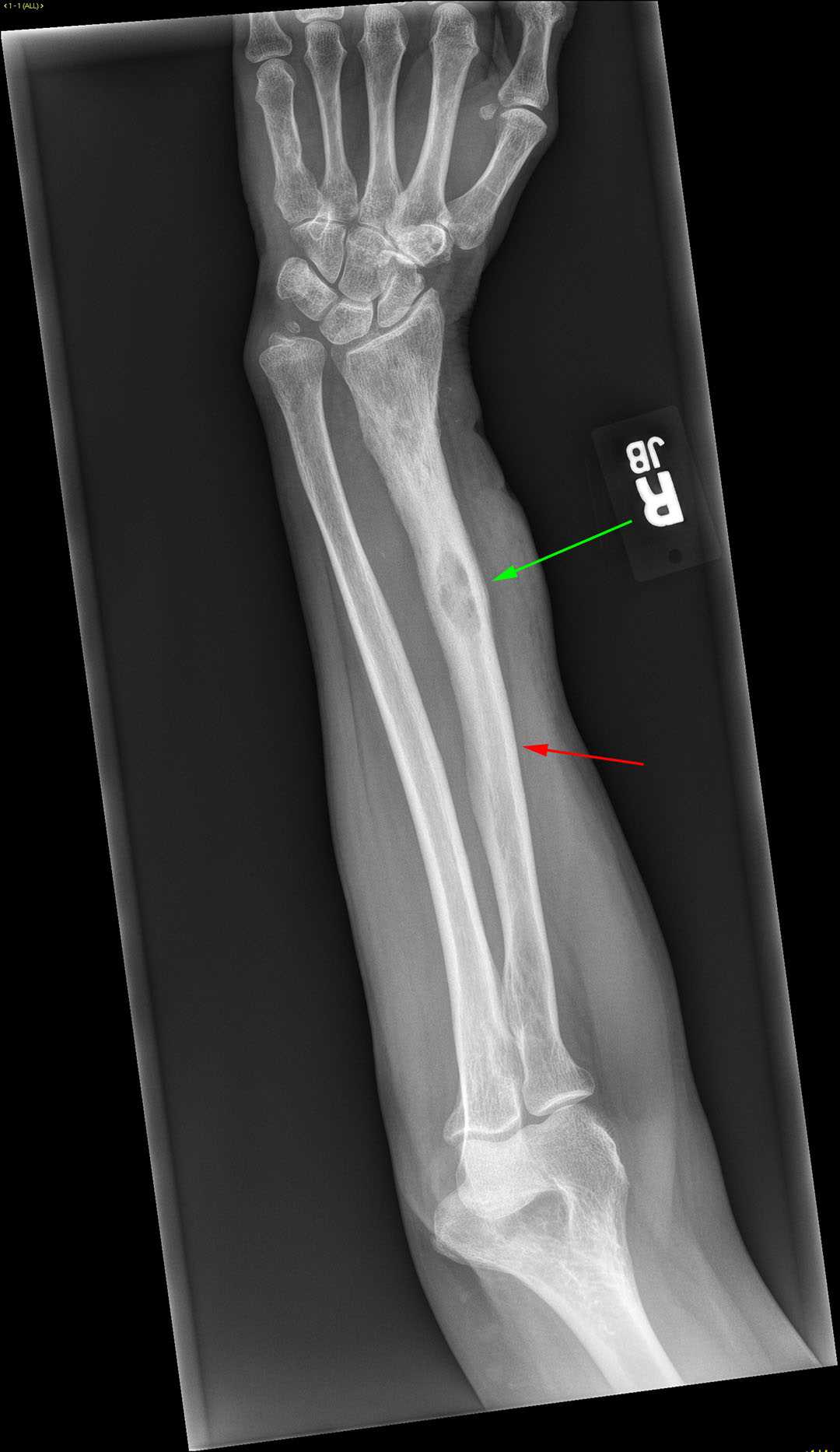 Brodies Abscess X Rays Case Studies CTisus CT Scanning