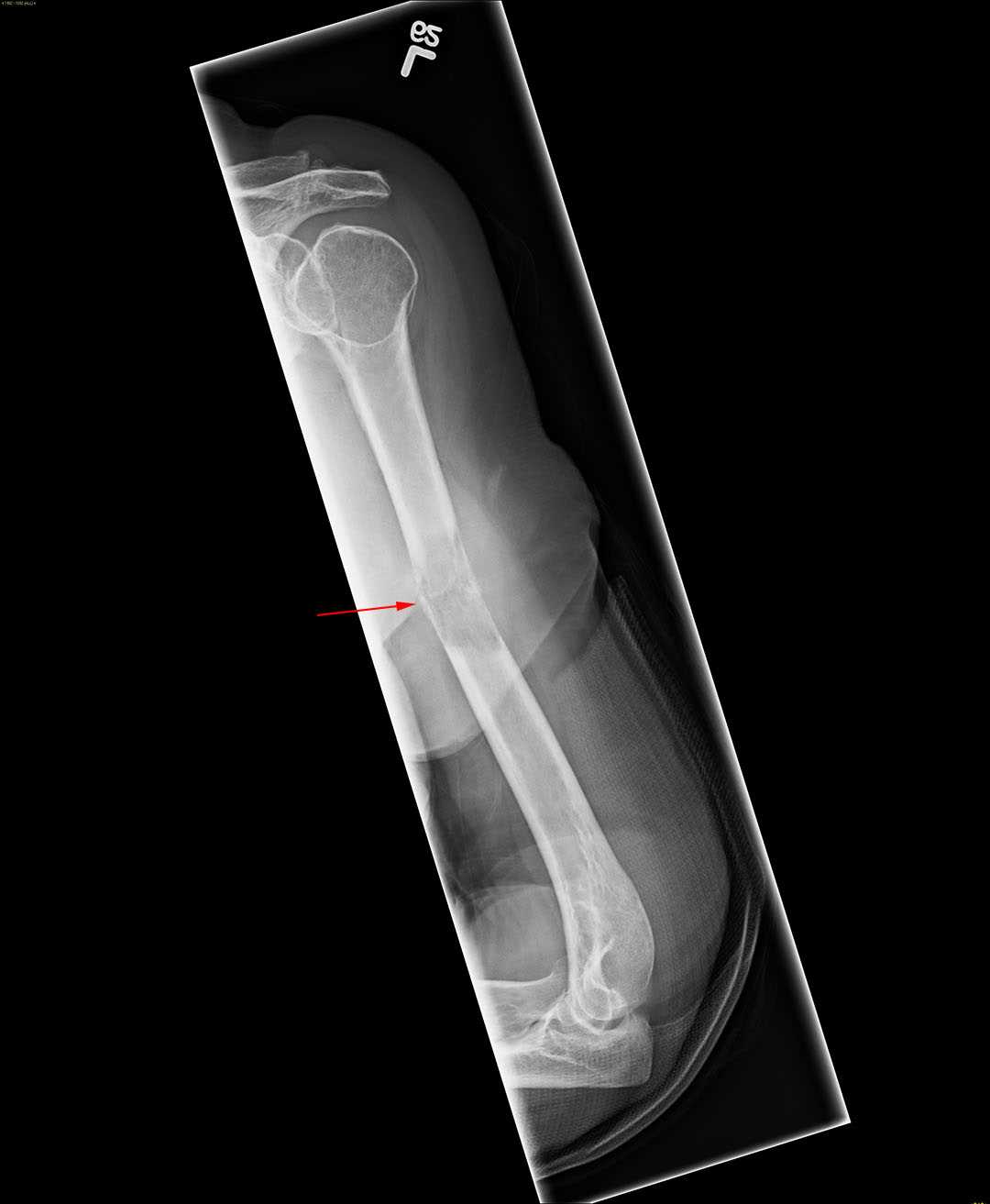 Metastatic thyroid cancer X Rays Case Studies CTisus CT Scanning