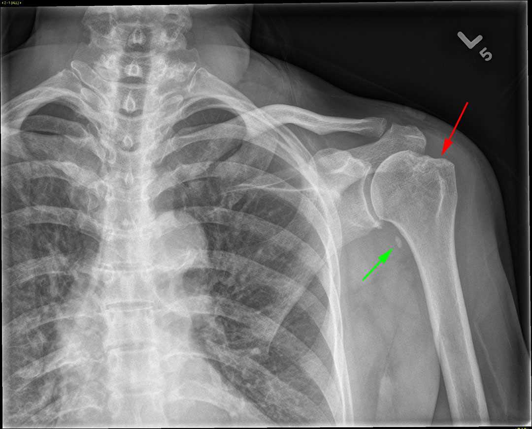 HillSachs Deformity X Rays Case Studies CTisus CT Scanning
